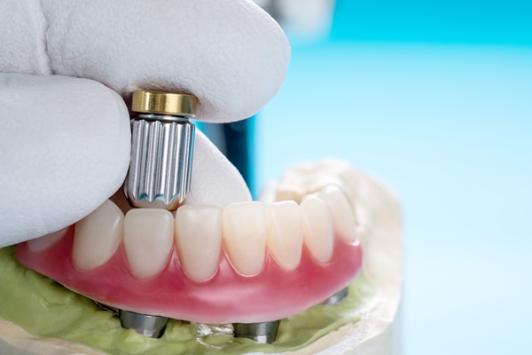When Are Implant Supported Dentures Recommended?